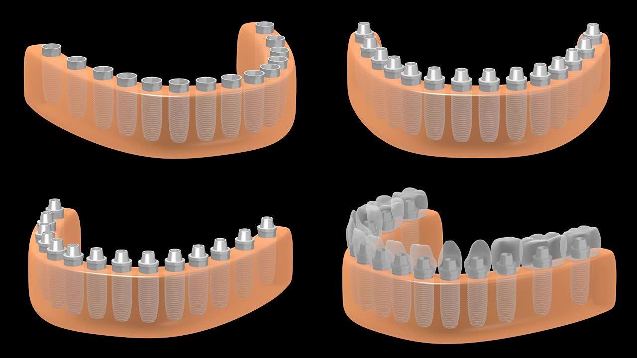 3D牙科植入物/牙齿植入物