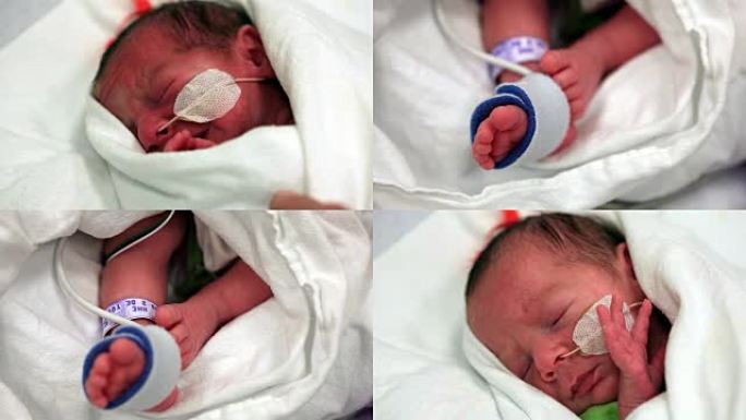用鼻饲管睡觉的早产男孩 (视频)。