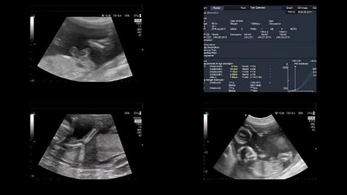 18周时同卵双胞胎心脏跳动的超声检查