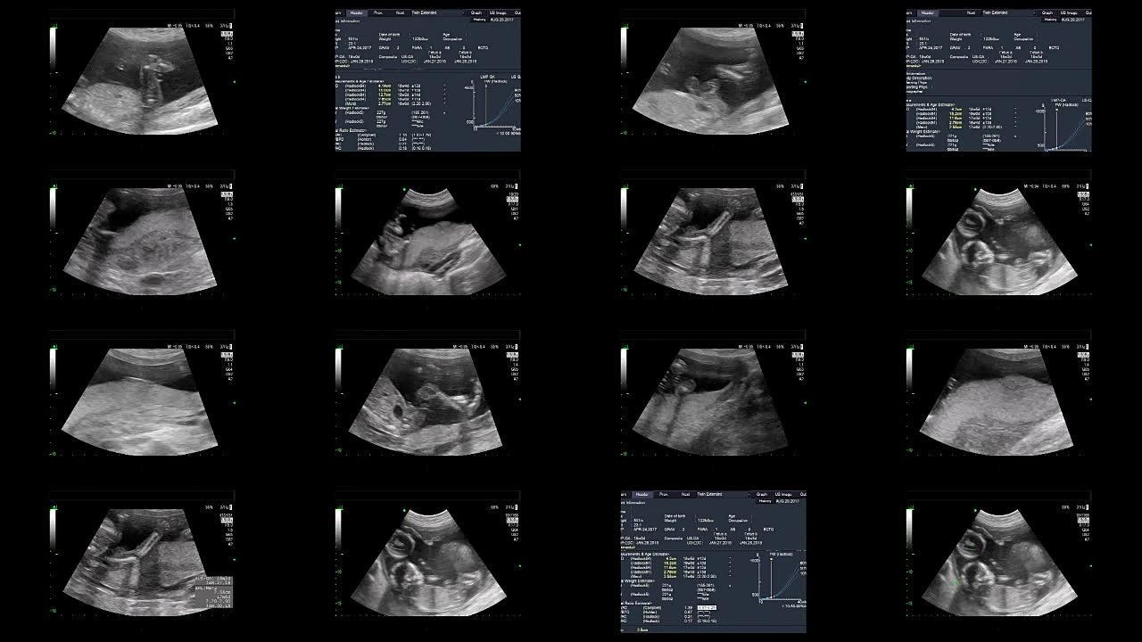 18周时同卵双胞胎心脏跳动的超声检查