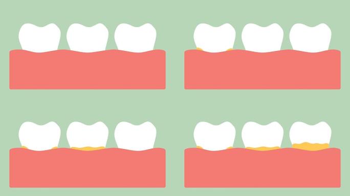 牙龈炎或牙龈疾病前牙龈上的斑块