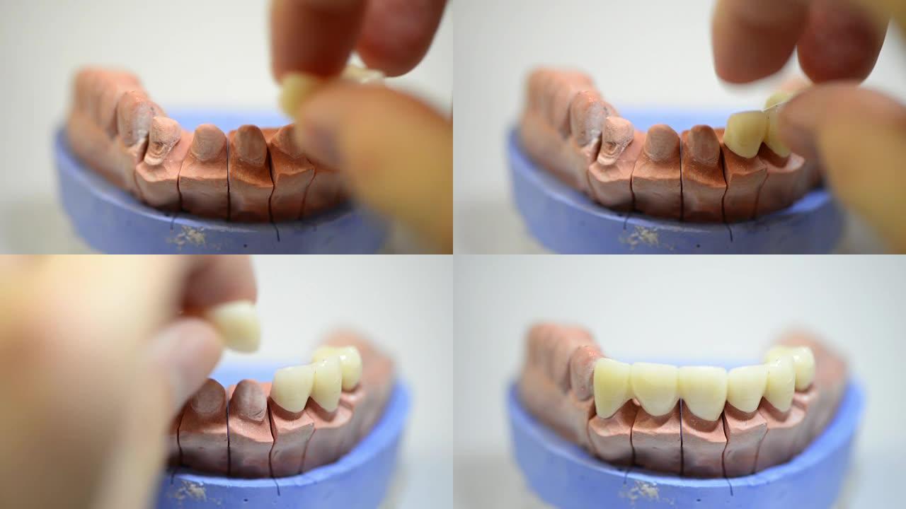 牙科技师正在研究用于牙种植的3D打印模具