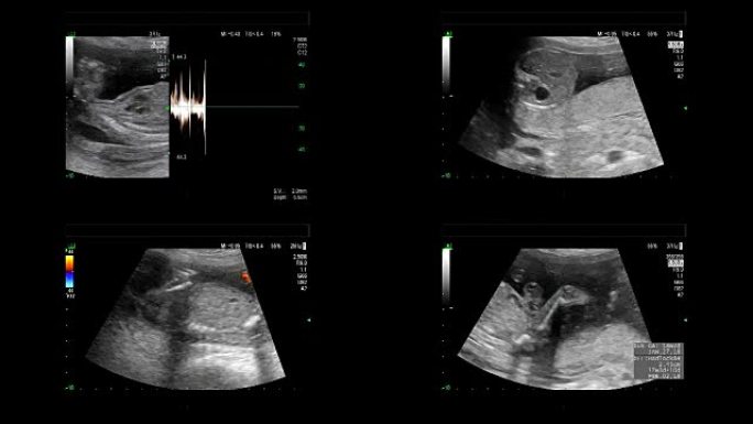 18周时同卵双胞胎心脏跳动的超声检查