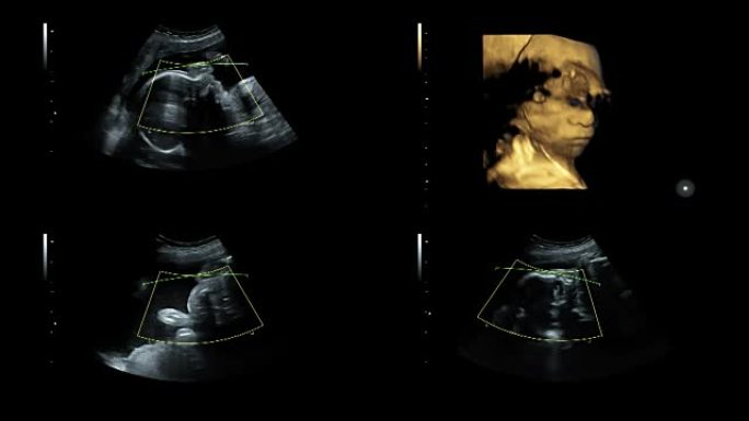 25周时同卵双胞胎心脏跳动的超声检查