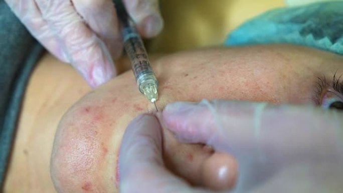美容师制作注射塑料嘴唇。诊所的年轻女子嘴唇增大