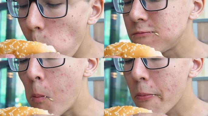 一个脸上长着粉刺的年轻人吃汉堡。