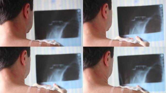 一名男子，右锁骨受到各种x射线图像的创伤。在图片中，可以看到他用金属板固定了锁骨。