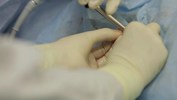 外科医生的手特写通过碎石方法从患者的肾脏中取出结石。