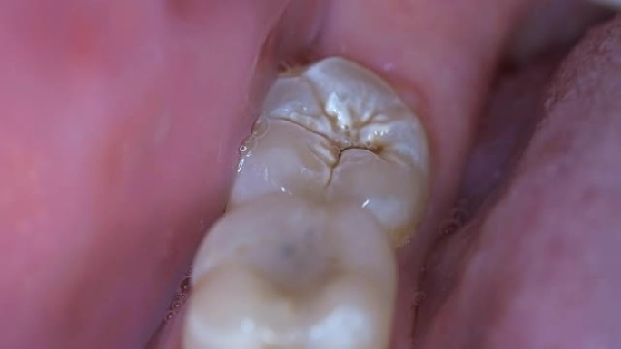 男人嘴里有龋齿的牙齿，特写