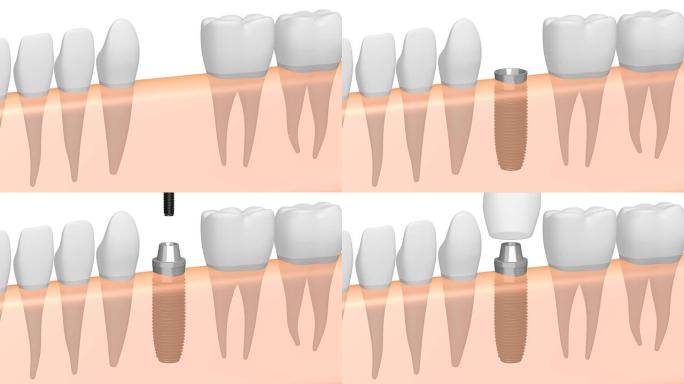 3D蛀牙/牙种植体
