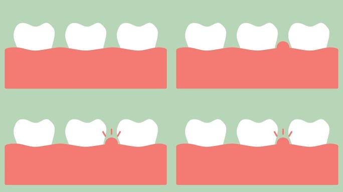牙龈炎或牙龈疾病，牙周病前牙龈发炎