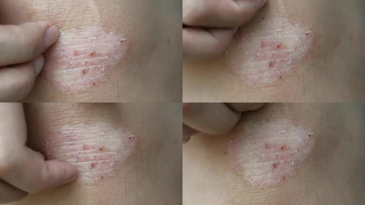 4k镜头的人抓挠皮肤，牛皮癣在膝盖上显示发红和应用和干燥片状皮肤和其他干燥的皮肤状况。