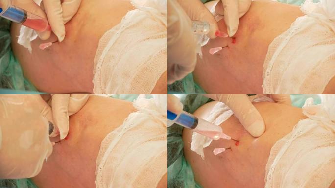 膝盖的医疗手术-医生和护士用注射器从患者的膝盖排出液体，特写