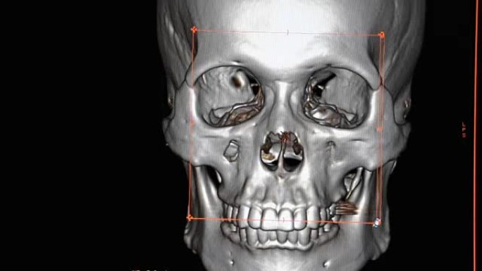 面部骨骼的3D渲染成像。
