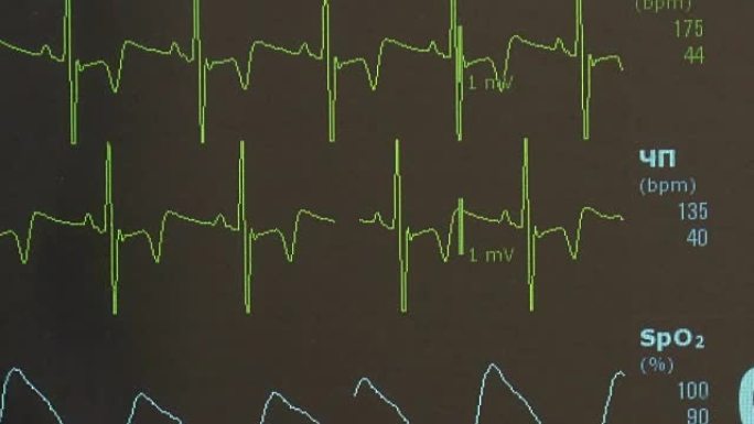 术中监护仪上心律和脉搏图像的心电图。