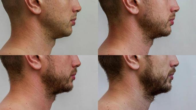 男性面部外侧部分长出年轻白种人的胡须