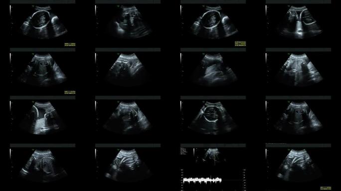 27周时同卵双胞胎心脏跳动的超声检查