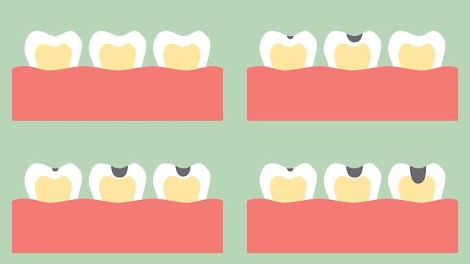 蛀牙或龋齿的阶段