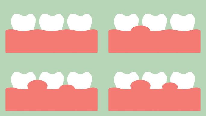 牙龈炎或牙龈疾病，牙周病前牙龈发炎