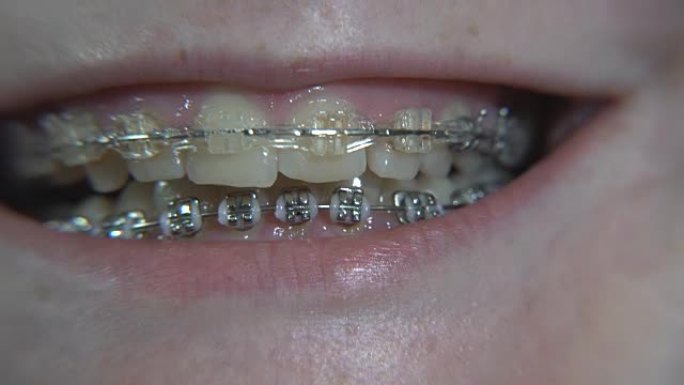 牙套。戴牙套的女孩在微笑。绿色rir