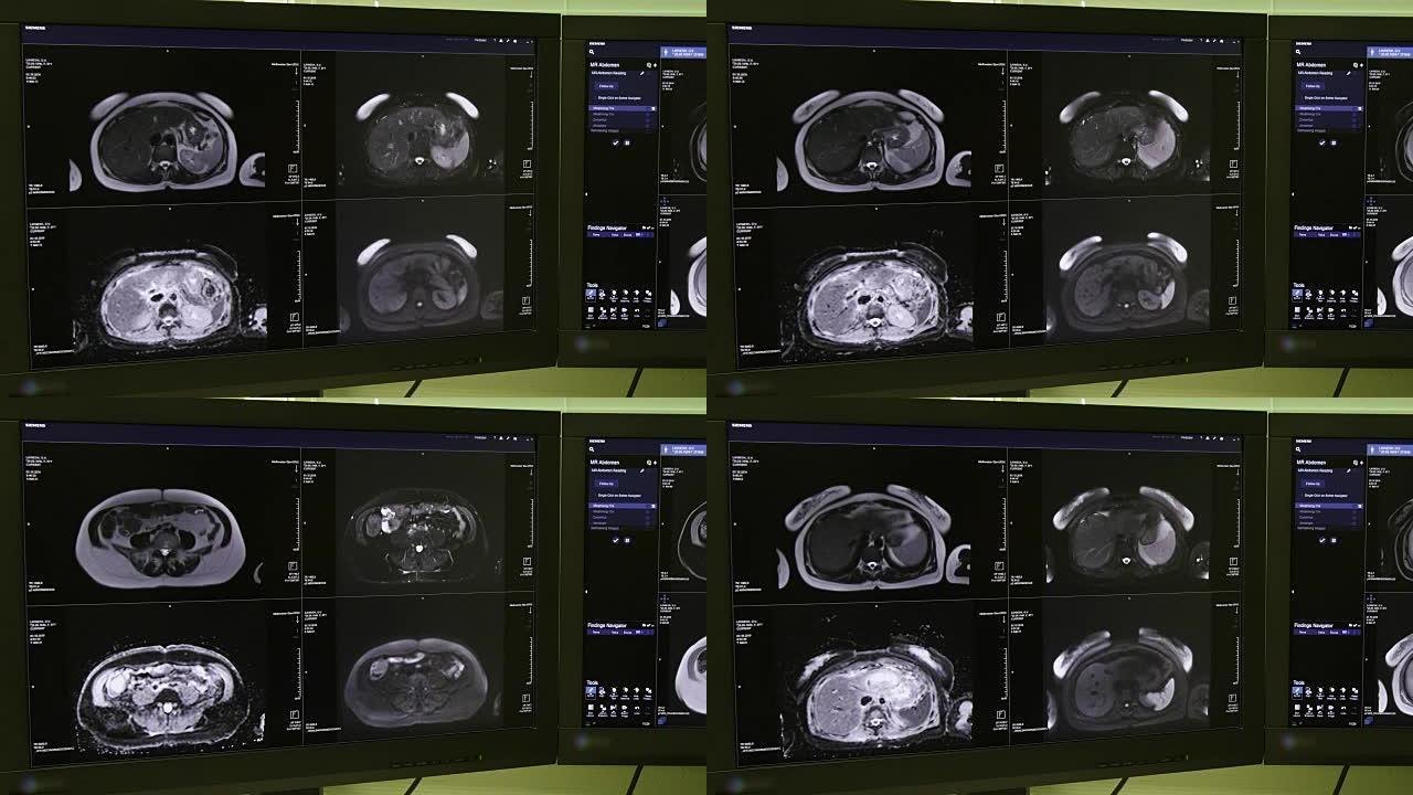 MRI扫描的脑部断层扫描。