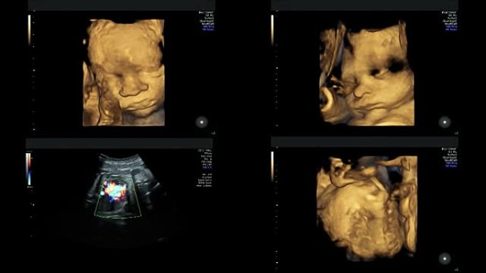 妊娠29周时同卵双胞胎的超声检查