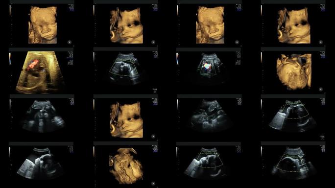 妊娠29周时同卵双胞胎的超声检查