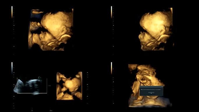 25周时同卵双胞胎心脏跳动的超声检查