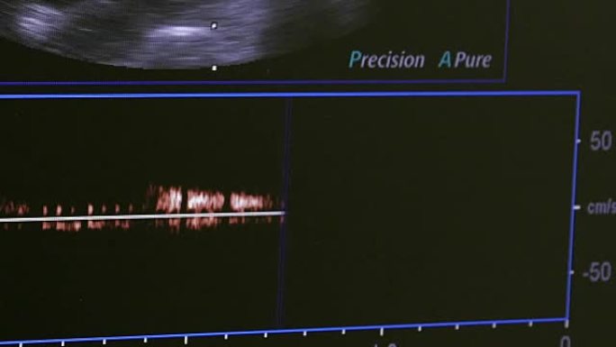 妇女子宫在超声检查设备上的图像。