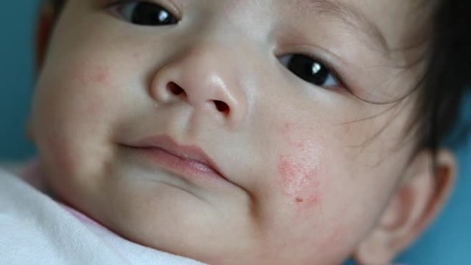 健康护理婴儿面部皮肤过敏性皮炎