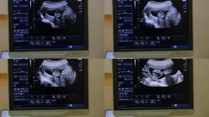 早孕婴儿胎儿超声声像图妊娠扫描屏幕
