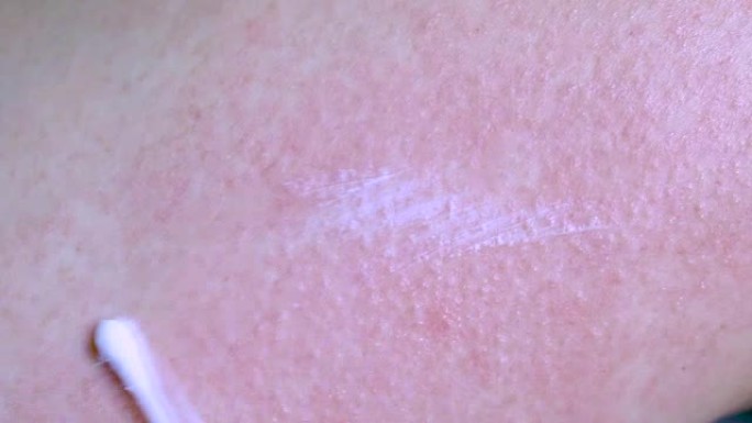 皮肤过敏性皮疹皮炎湿疹。