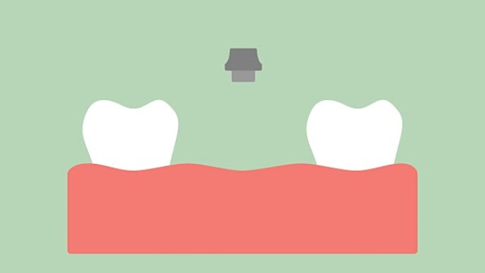 牙种植体、安装过程和牙齿的变化