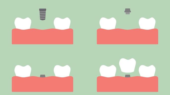 牙种植体、安装过程和牙齿的变化