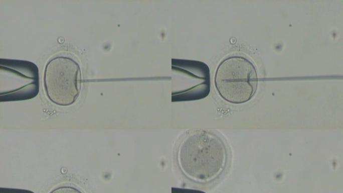 精子注射 (PAL)