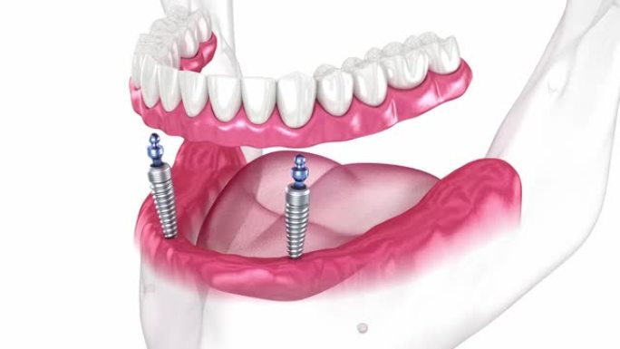 下颌骨可移动假体全部在2系统上由带有球附件的植入物支撑。牙科3D动画
