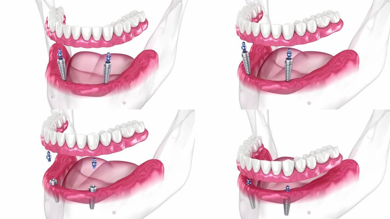 下颌骨可移动假体全部在2系统上由带有球附件的植入物支撑。牙科3D动画