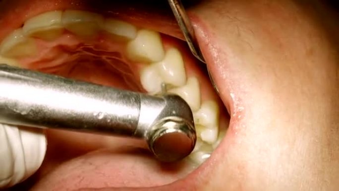 牙医在汞合金上使用钻头