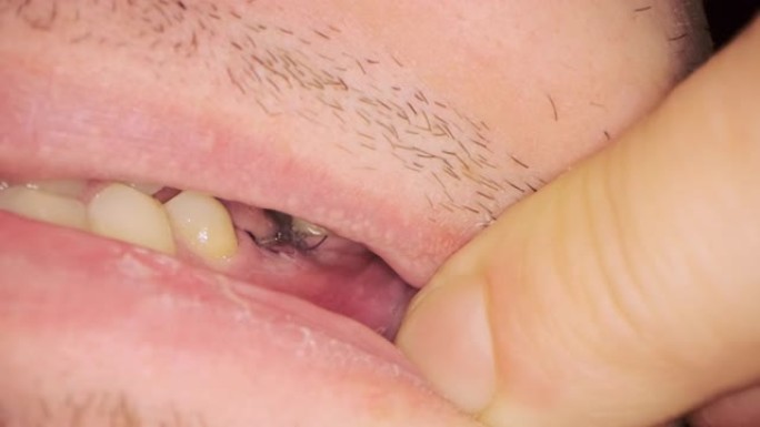 男性患者牙龈上有黑线的接缝