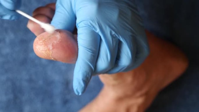 医生在脚趾受损的皮肤上涂抹愈合药膏。