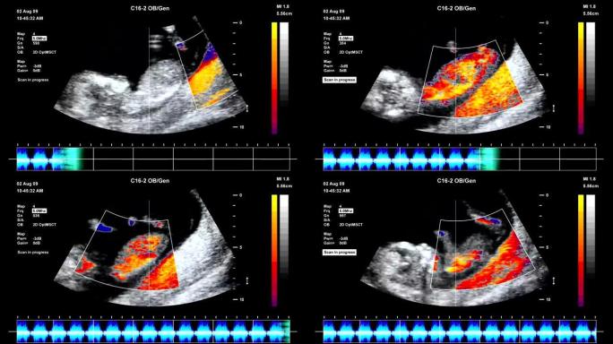 胎儿超声扫描幼声胎观儿探