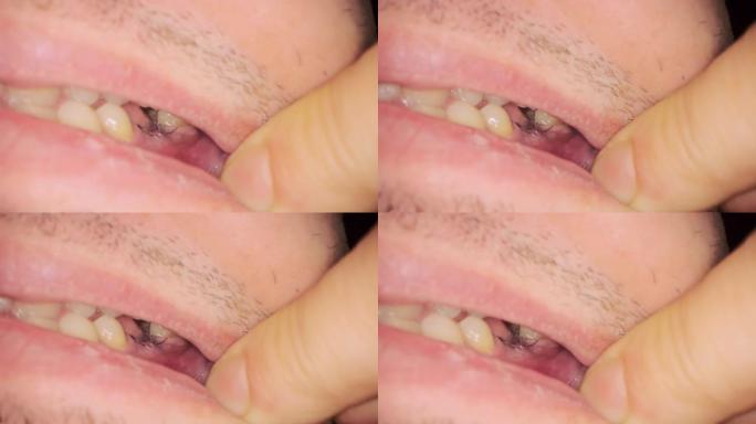 男性患者张开嘴显示黑线接缝