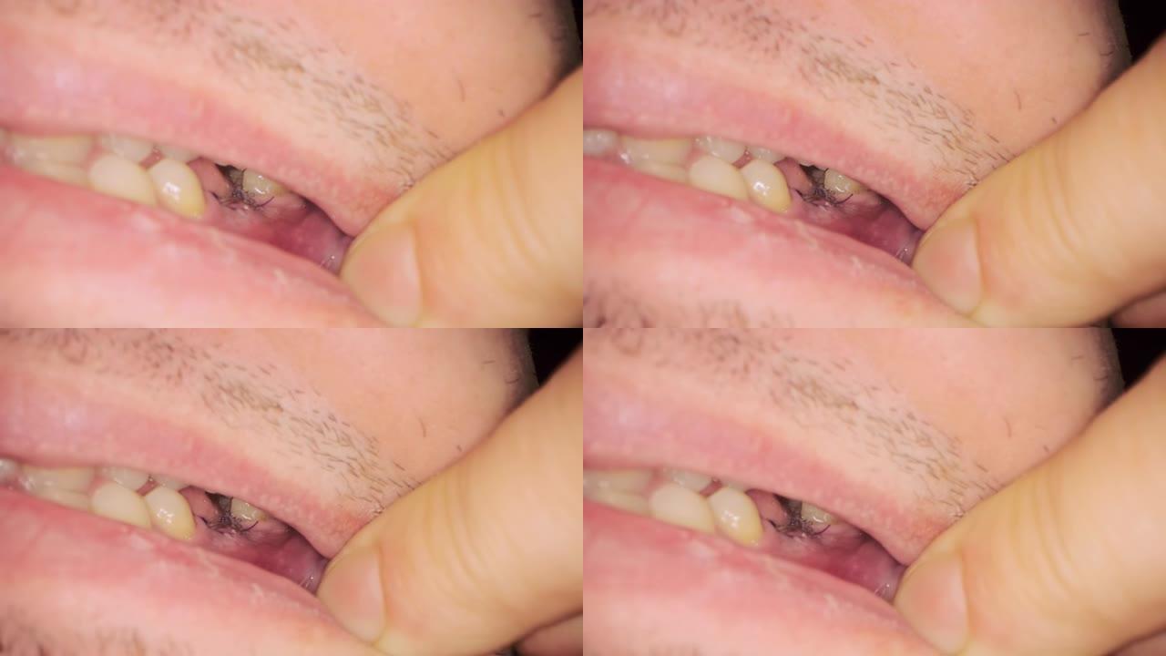 男性患者张开嘴显示黑线接缝