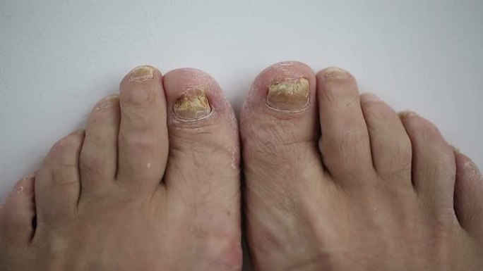 脚趾甲感染真菌
