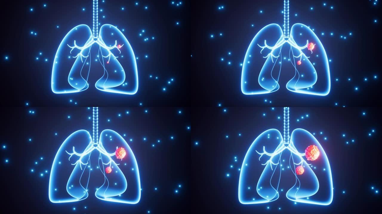 人肺肿瘤，人肺癌，三维渲染。