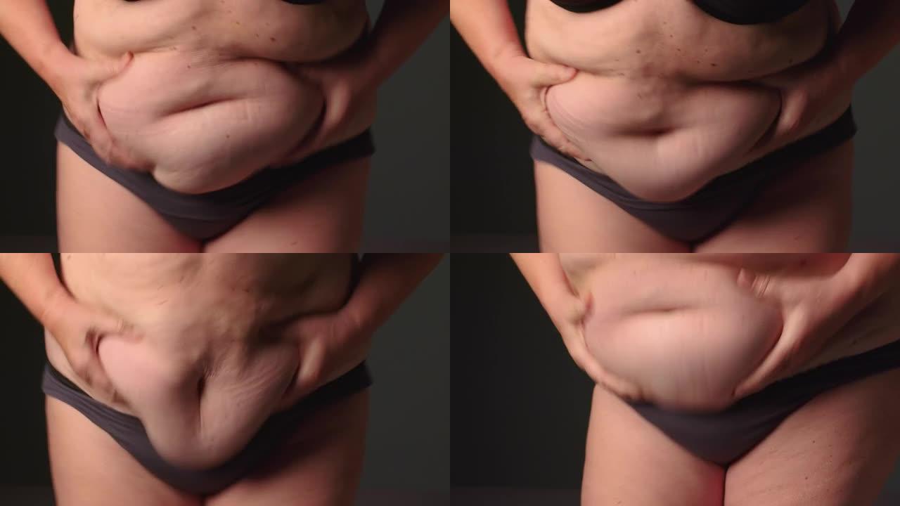 超重沉重的老年妇女捏她的腹部脂肪，暴饮暴食问题，肥胖。体重人的身体脂肪多于最佳体重，体重指数，不健康
