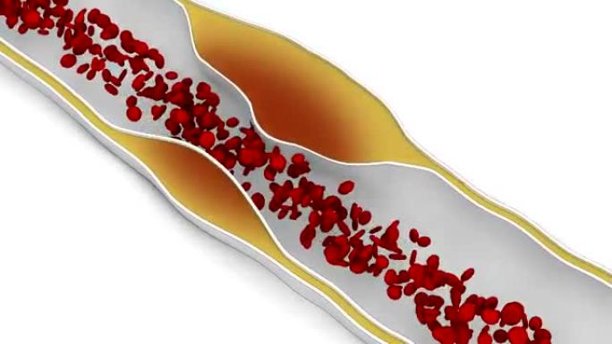 冠状动脉粥样硬化-脂肪细胞阻断血流