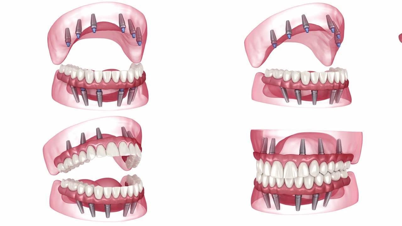 由6个植入物支撑的假体。牙科3D动画