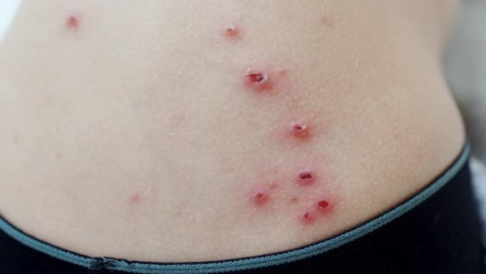 皮肤上有水痘水泡，无法辨认的患儿