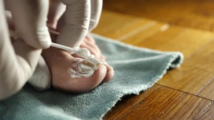 将药膏涂在受真菌影响的大脚趾上。指甲真菌的治疗。